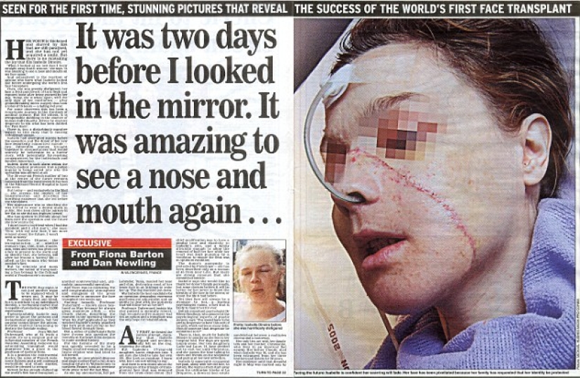 The first woman with a transplanted face died of cancer caused by anti-rejection drugs The first woman with a transplanted face died of cancer caused by anti-rejection drugs