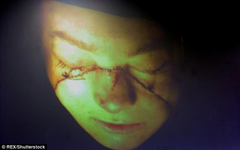The first woman with a transplanted face died of cancer caused by anti-rejection drugs The first woman with a transplanted face died of cancer caused by anti-rejection drugs