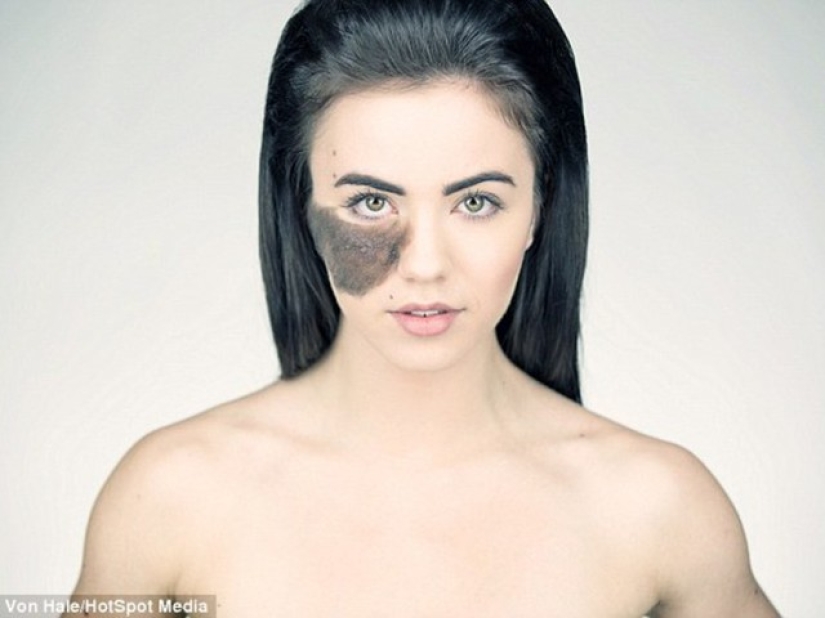 The girl refuses to remove the birthmark, considering it her highlight