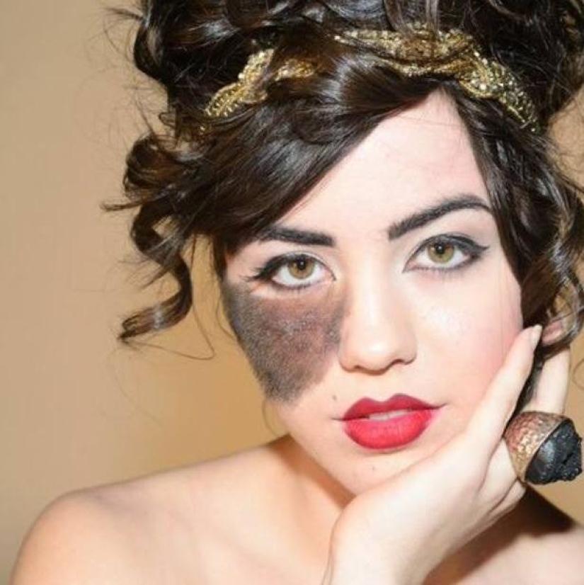 The girl refuses to remove the birthmark, considering it her highlight