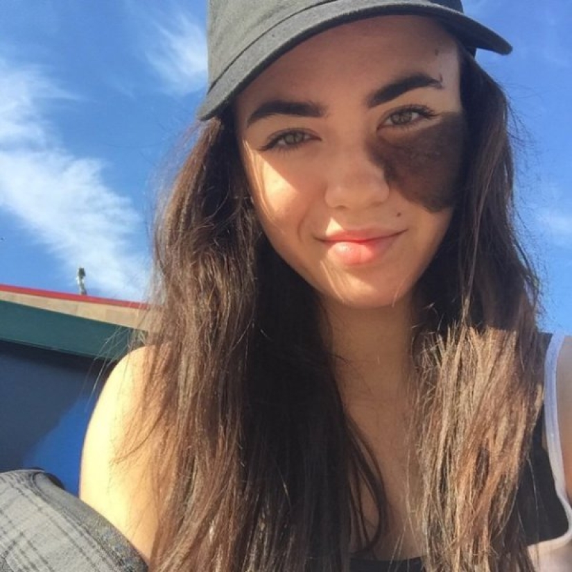 The girl refuses to remove the birthmark, considering it her highlight