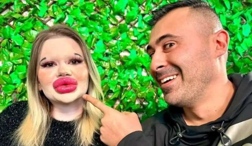 The girl with the biggest lips in the world decided to enlarge her cheekbones The girl with the biggest lips in the world decided to enlarge her cheekbones