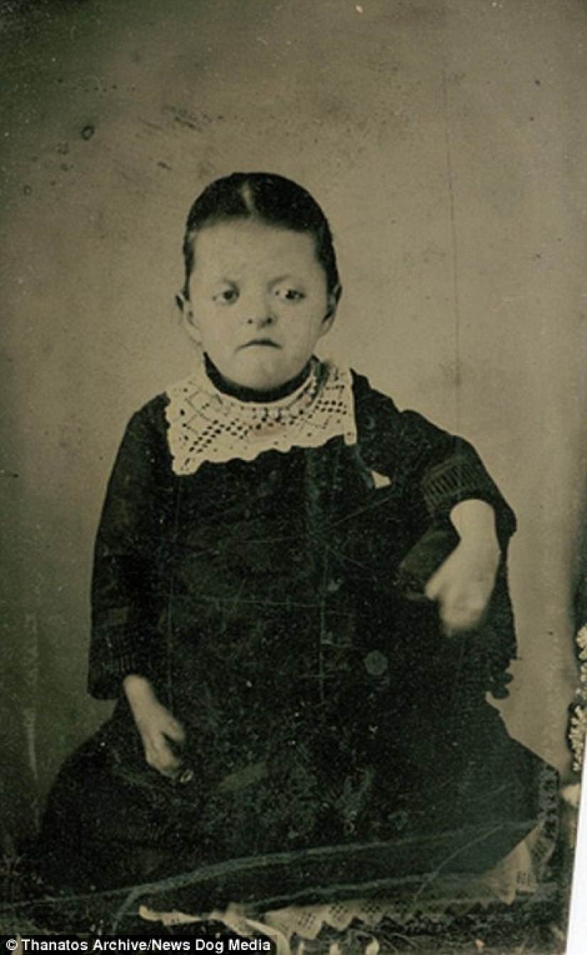 The harsh XIX century: a collection of archival photographs of people with deformities