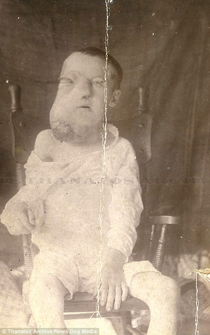The harsh XIX century: a collection of archival photographs of people with deformities