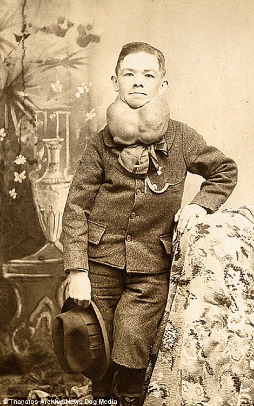 The harsh XIX century: a collection of archival photographs of people with deformities