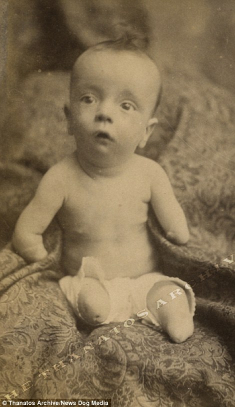 The harsh XIX century: a collection of archival photographs of people with deformities