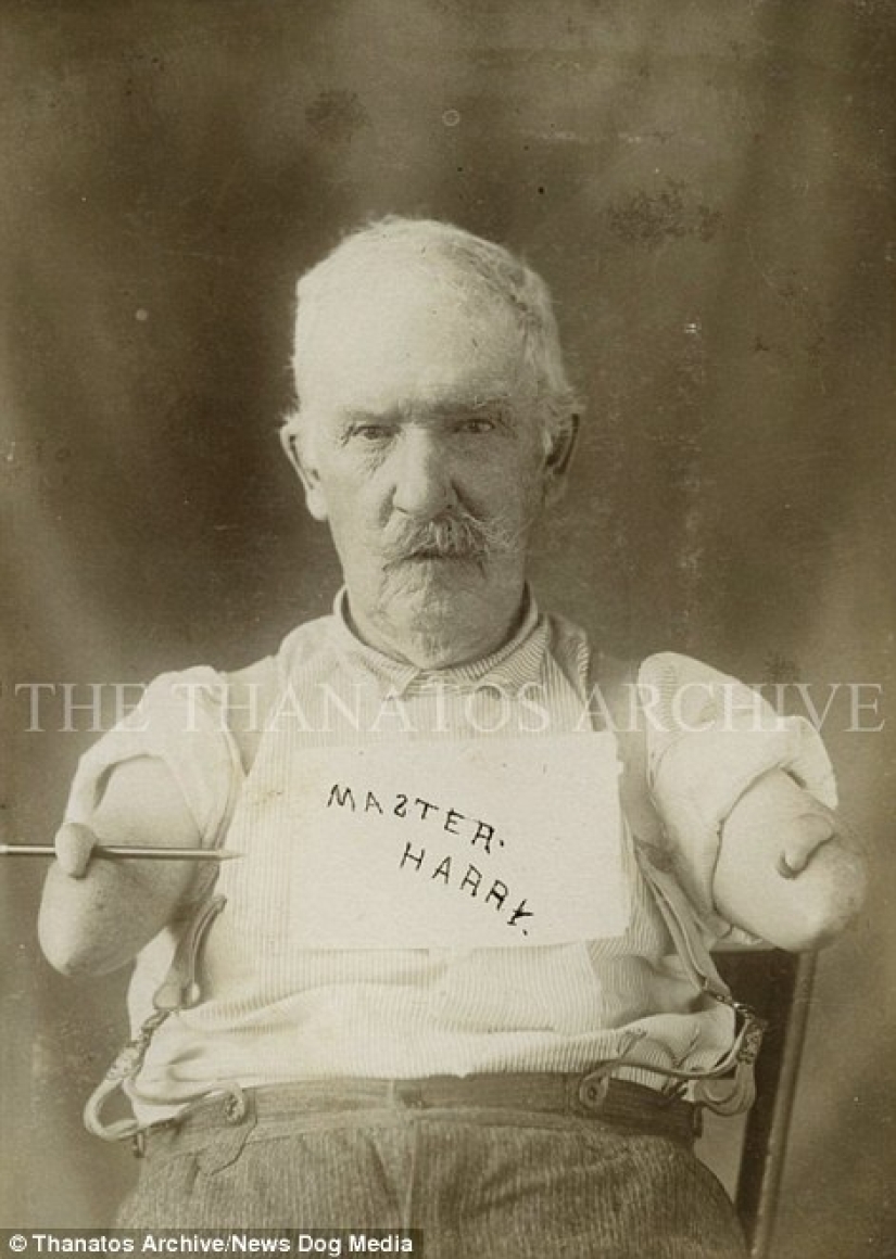 The harsh XIX century: a collection of archival photographs of people with deformities