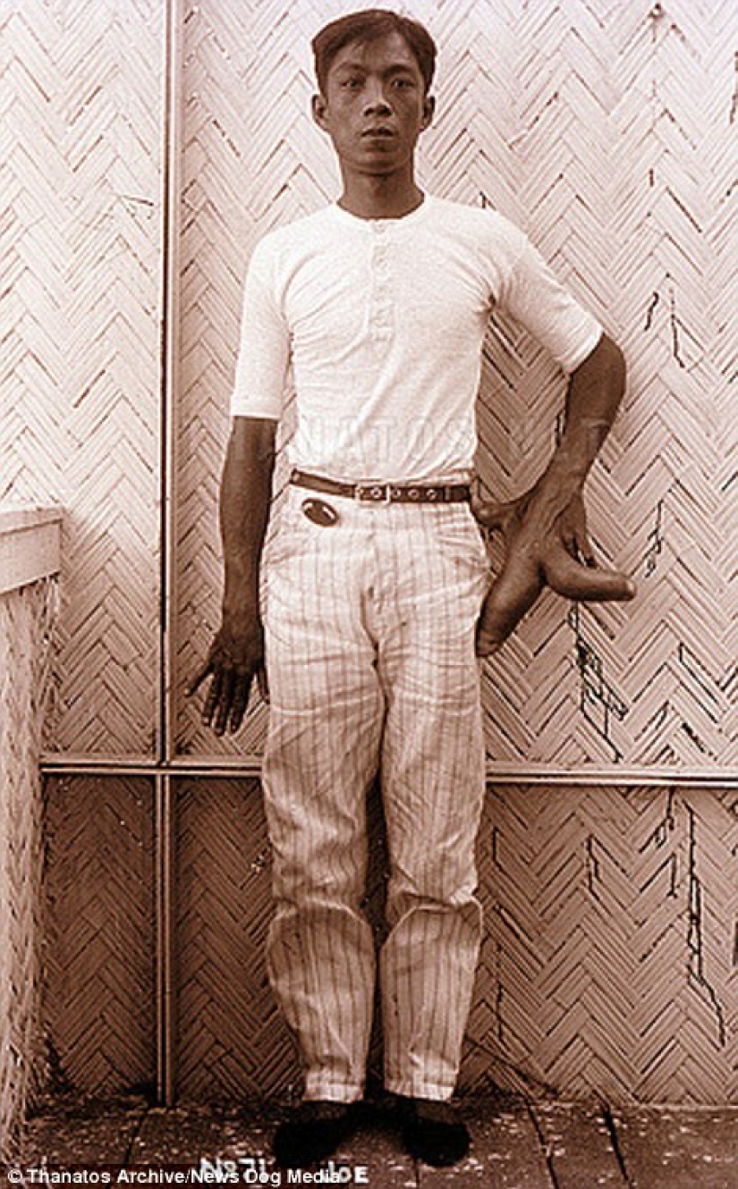 The harsh XIX century: a collection of archival photographs of people with deformities