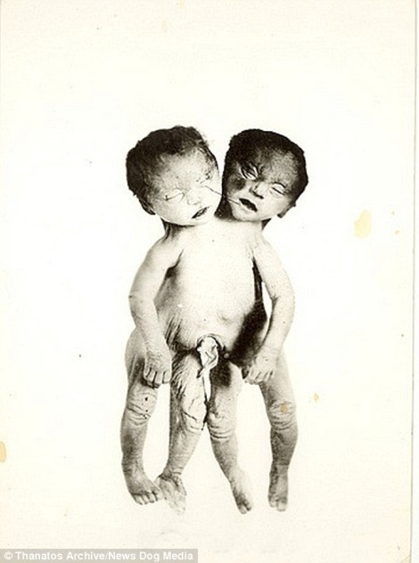 The harsh XIX century: a collection of archival photographs of people with deformities