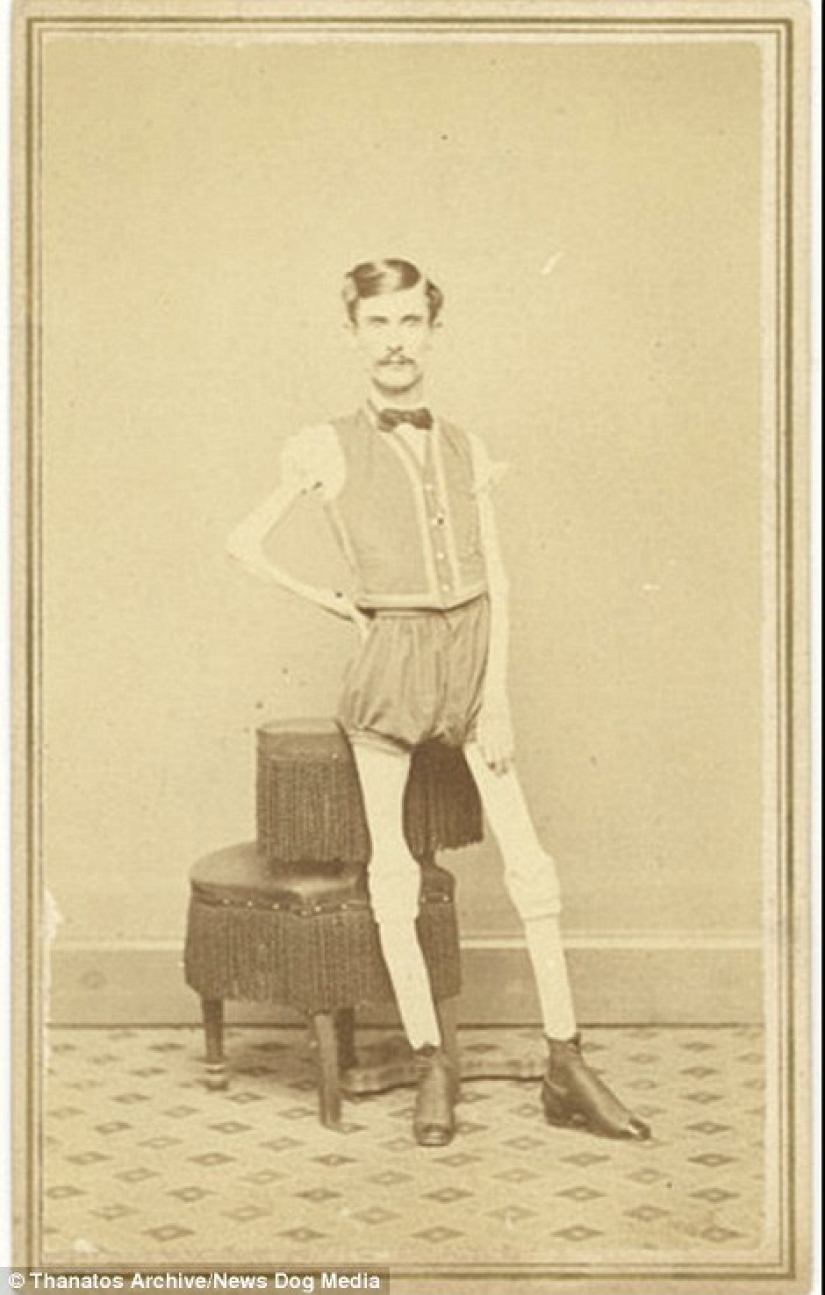 The harsh XIX century: a collection of archival photographs of people with deformities
