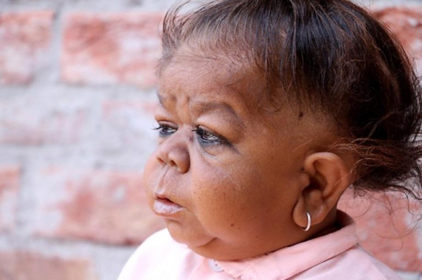 The inexplicable story of a 21-year-old Indian who got stuck in the body of a baby