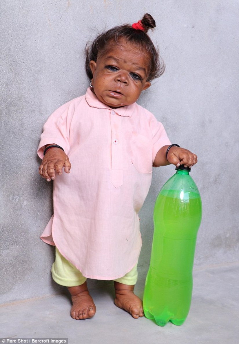 The inexplicable story of a 21-year-old Indian who got stuck in the body of a baby