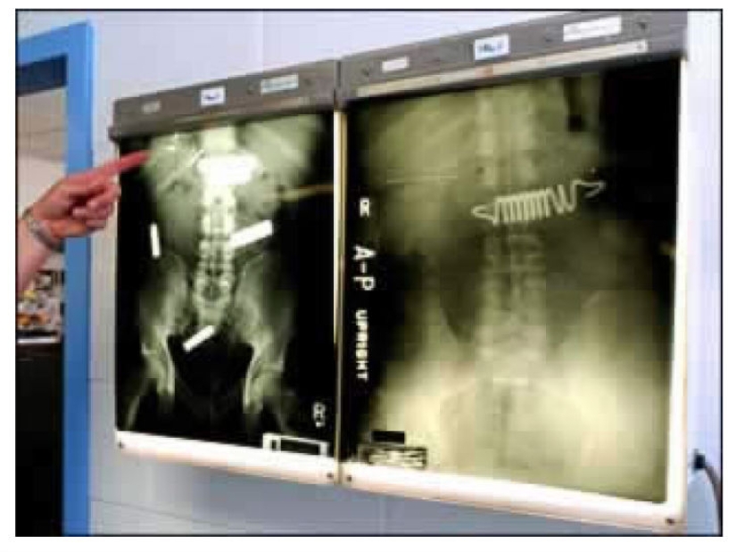 The most creepy objects that have ever been found in a human stomach
