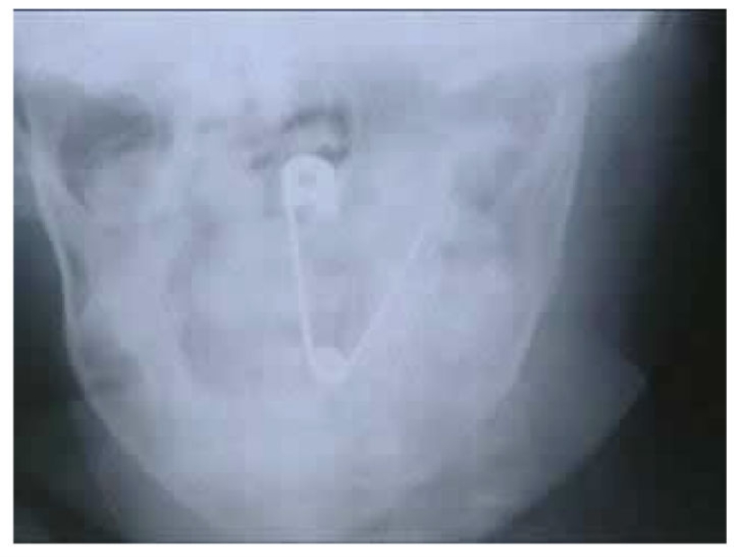 The most creepy objects that have ever been found in a human stomach