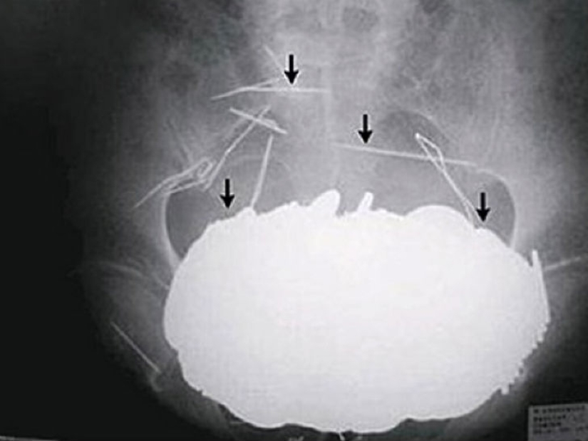 The most creepy objects that have ever been found in a human stomach