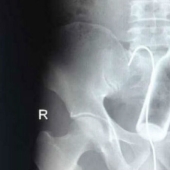 The most creepy objects that have ever been found in a human stomach