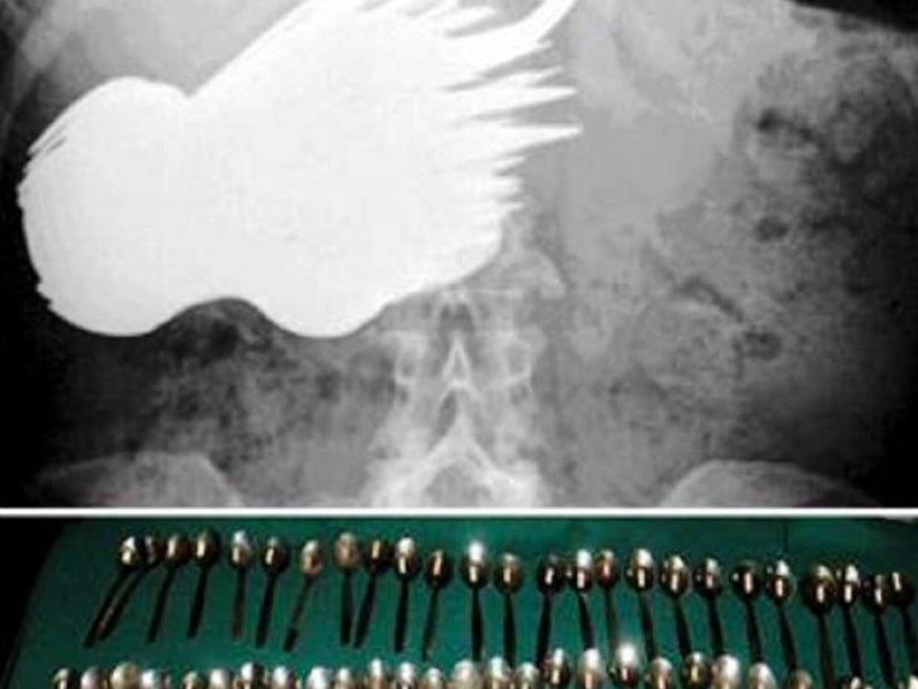 The most creepy objects that have ever been found in a human stomach