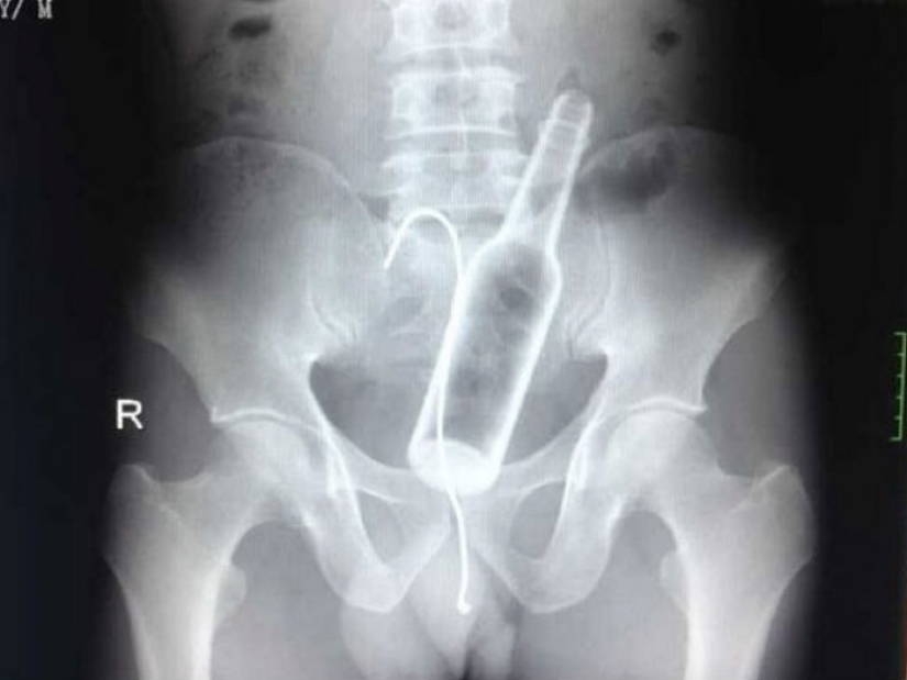 The most creepy objects that have ever been found in a human stomach