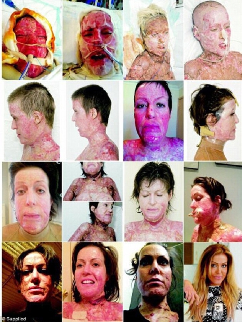 The once almost burned alive Australian woman finally took off her mask The once almost burned alive Australian woman finally took off her mask