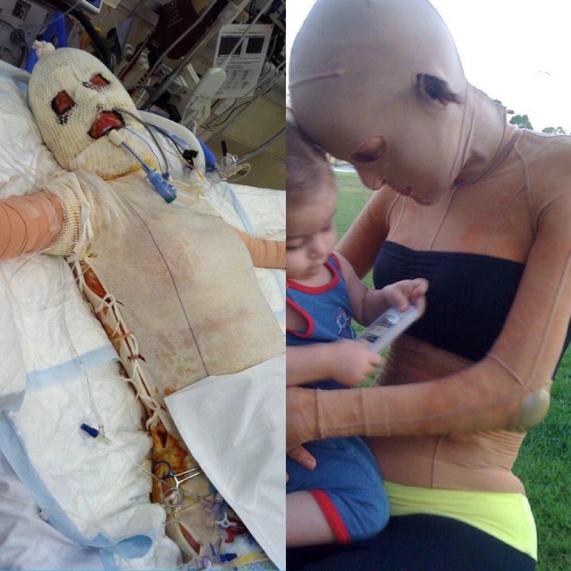 The once almost burned alive Australian woman finally took off her mask The once almost burned alive Australian woman finally took off her mask
