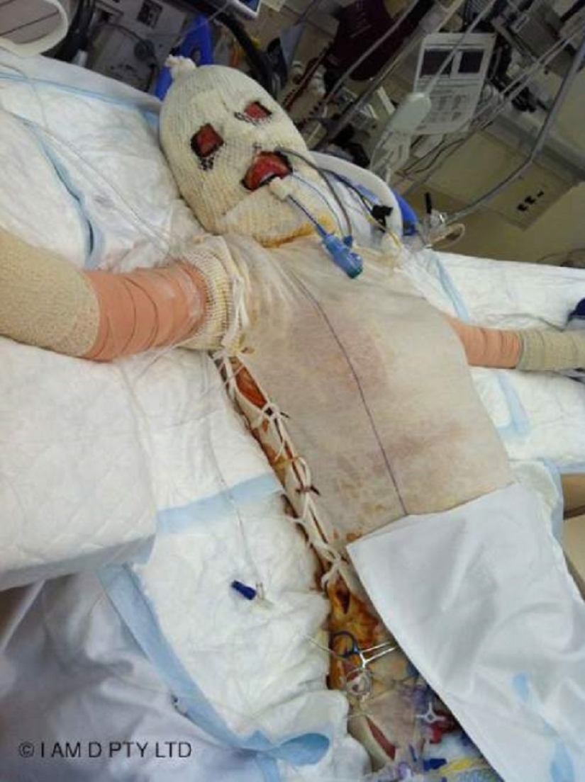 The once almost burned alive Australian woman finally took off her mask The once almost burned alive Australian woman finally took off her mask