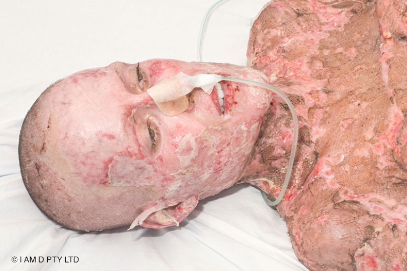 The once almost burned alive Australian woman finally took off her mask The once almost burned alive Australian woman finally took off her mask