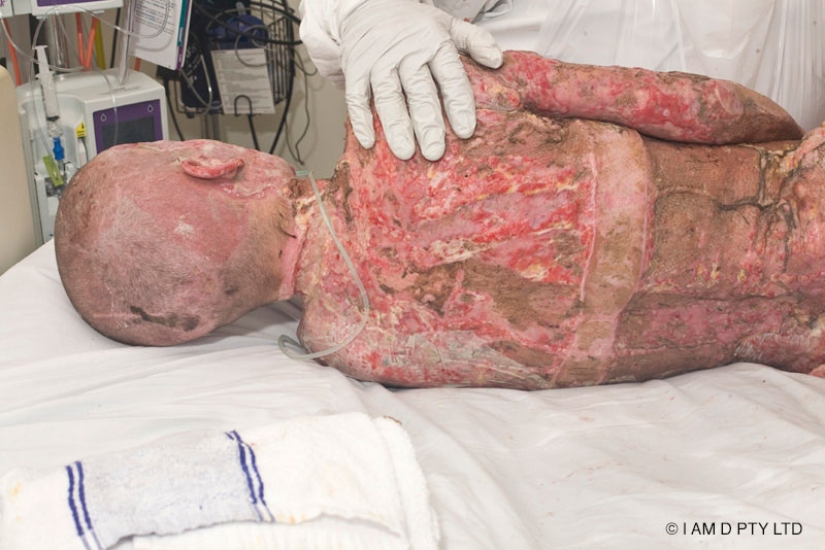 The once almost burned alive Australian woman finally took off her mask The once almost burned alive Australian woman finally took off her mask