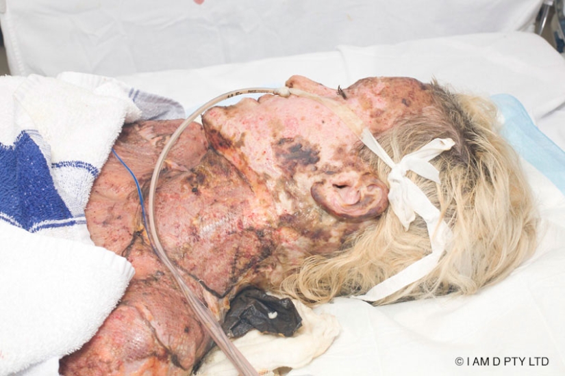 The once almost burned alive Australian woman finally took off her mask The once almost burned alive Australian woman finally took off her mask