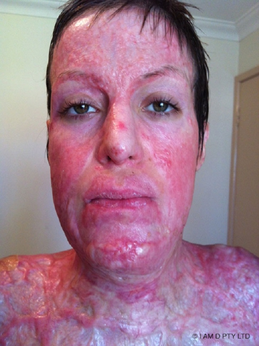The once almost burned alive Australian woman finally took off her mask The once almost burned alive Australian woman finally took off her mask