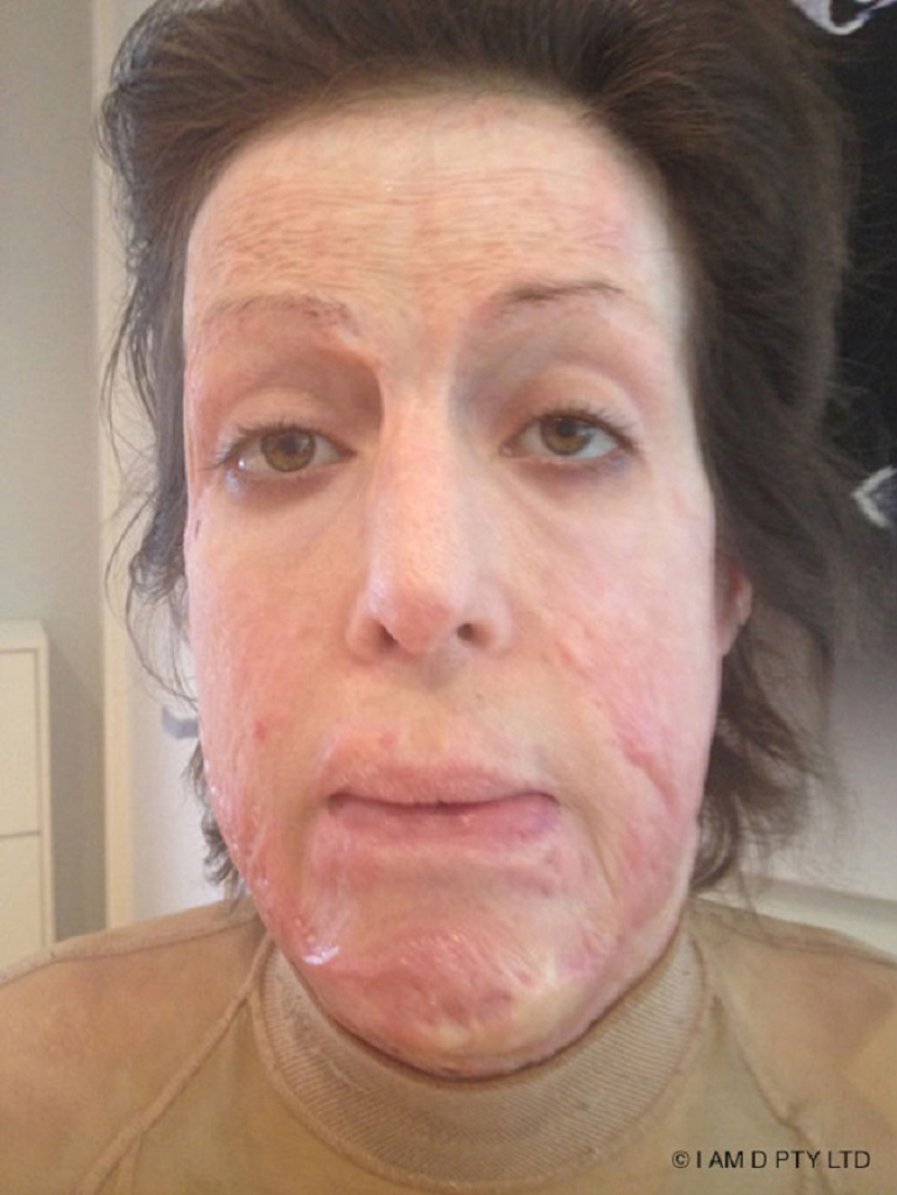The once almost burned alive Australian woman finally took off her mask The once almost burned alive Australian woman finally took off her mask