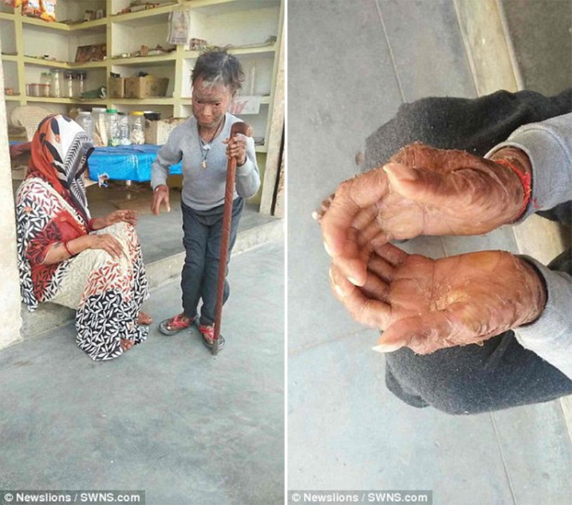 The snake girl sheds her skin every six weeks