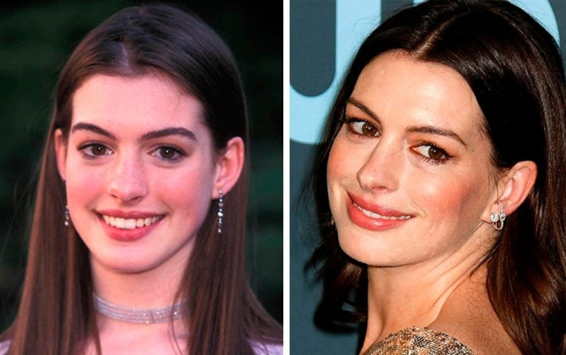 The surgeon did a great job: 10 stars with perfect facial plastic surgery