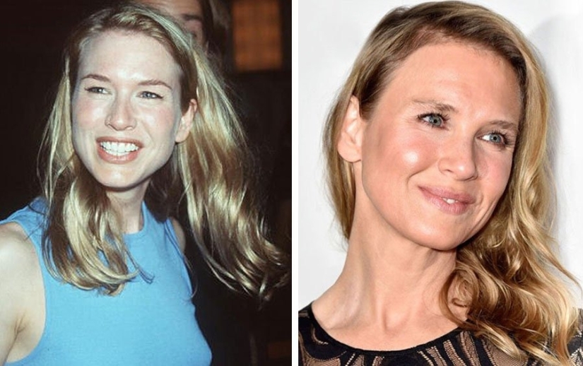 The surgeon did a great job: 10 stars with perfect facial plastic surgery