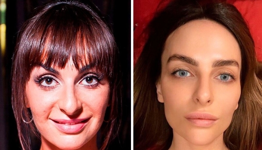 The surgeon did a great job: 10 stars with perfect facial plastic surgery