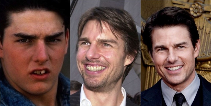 These celebrities will show you how braces can dramatically change your smile