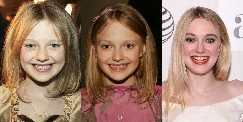 These celebrities will show you how braces can dramatically change your smile
