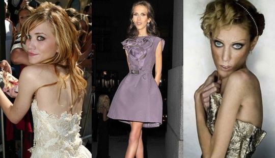 They were afraid to get fat: 9 stars who were ruined by anorexia