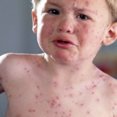 Todo lo que necesita saber sobre el virus Coxsackie