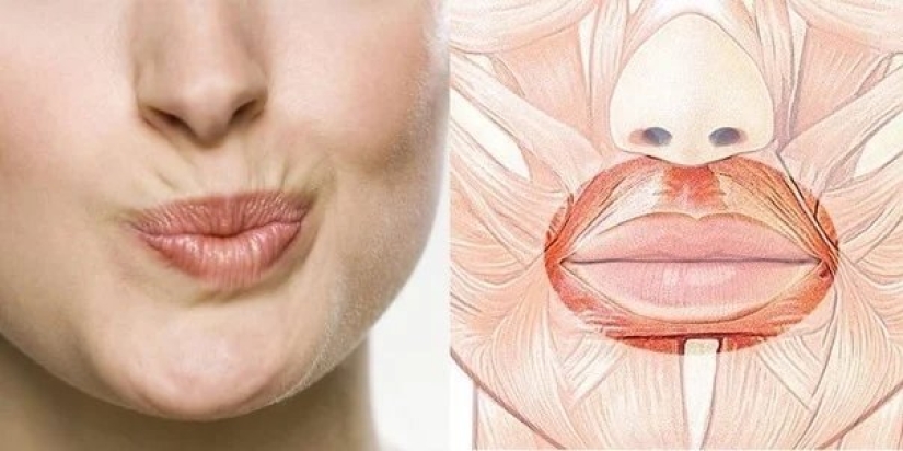 We remove a sad, dissatisfied face along with nasolabial wrinkles and increase the volume of the lips