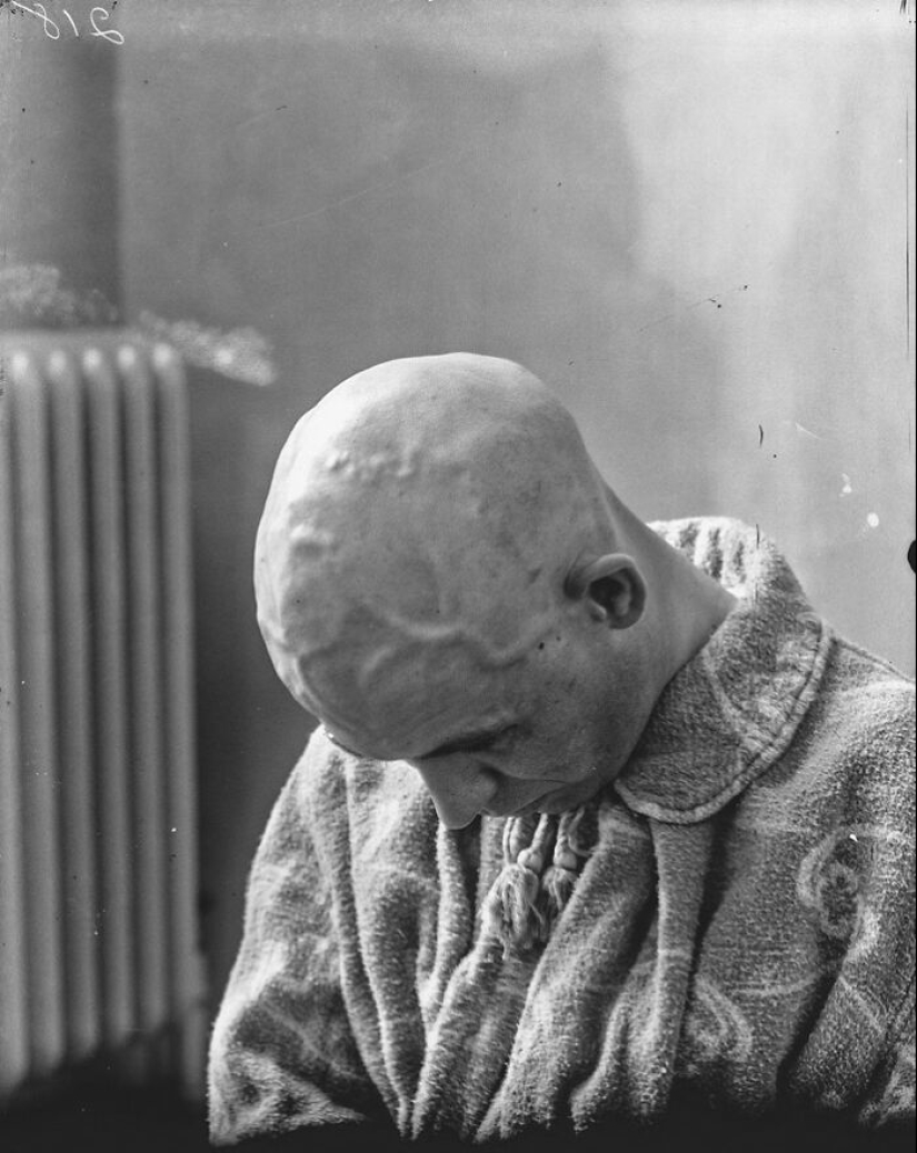 11 Haunting Medical Portraits Of Harvey Cushing’s Patients In The Early 20th Century 11 Haunting Medical Portraits Of Harvey Cushing’s Patients In The Early 20th Century