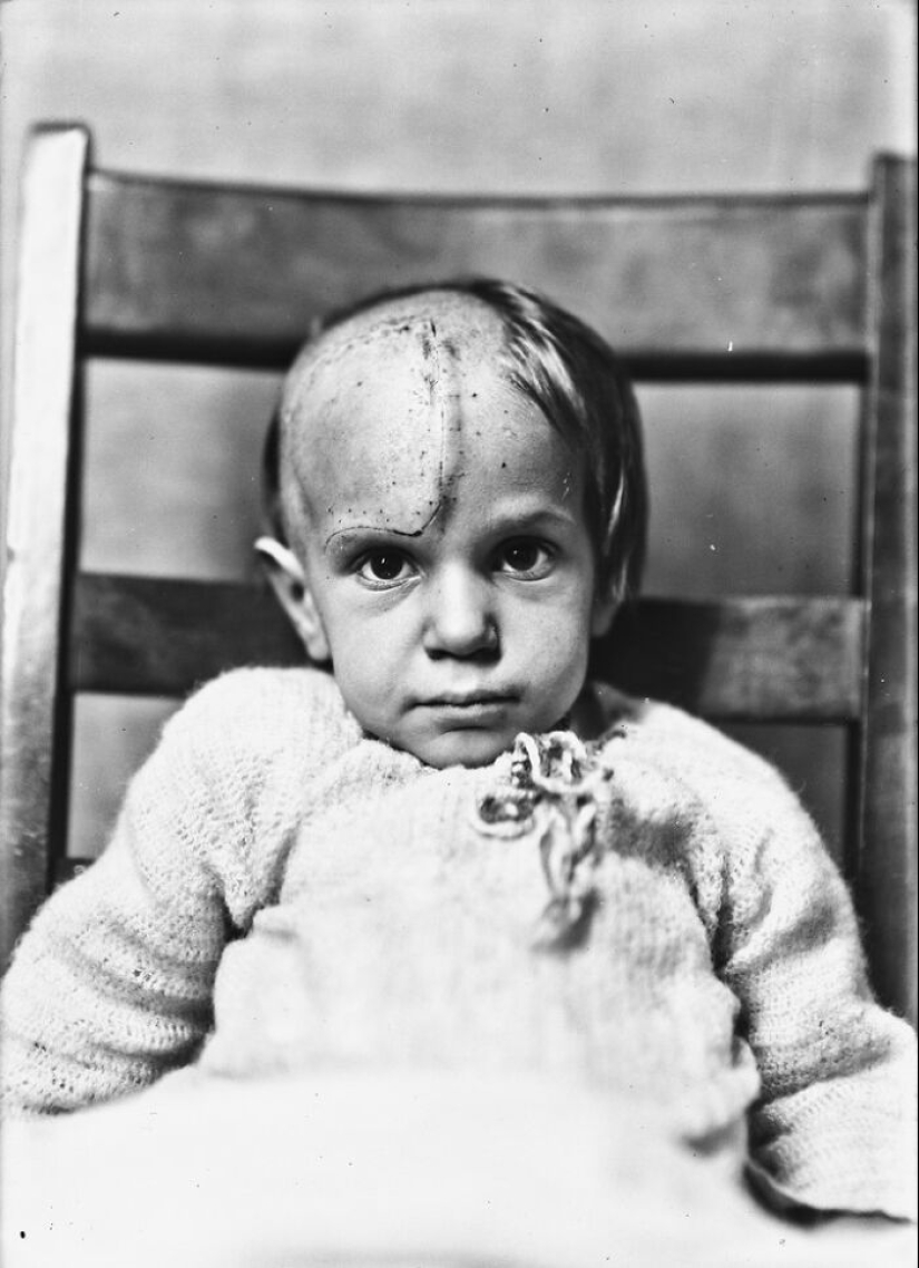 11 Haunting Medical Portraits Of Harvey Cushing’s Patients In The Early 20th Century 11 Haunting Medical Portraits Of Harvey Cushing’s Patients In The Early 20th Century