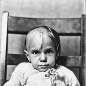 11 Haunting Medical Portraits Of Harvey Cushing’s Patients In The Early 20th Century 11 Haunting Medical Portraits Of Harvey Cushing’s Patients In The Early 20th Century