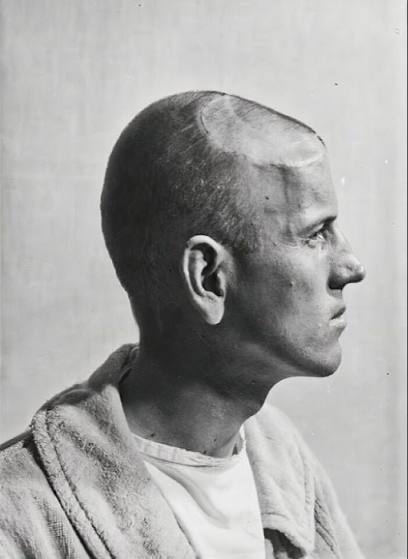 11 Haunting Medical Portraits Of Harvey Cushing’s Patients In The Early 20th Century 11 Haunting Medical Portraits Of Harvey Cushing’s Patients In The Early 20th Century