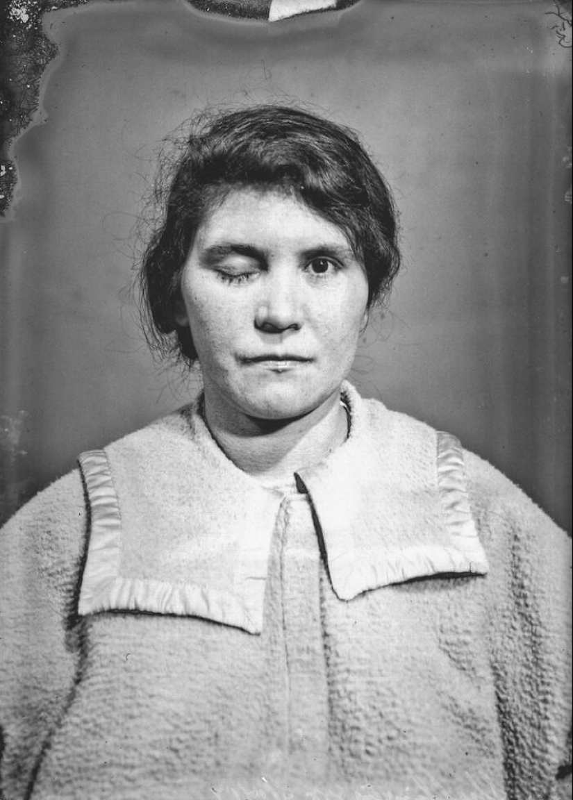 11 Haunting Medical Portraits Of Harvey Cushing’s Patients In The Early 20th Century 11 Haunting Medical Portraits Of Harvey Cushing’s Patients In The Early 20th Century