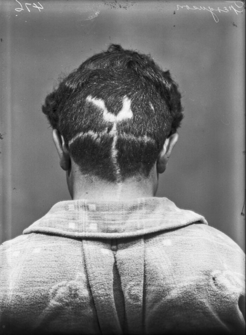 11 Haunting Medical Portraits Of Harvey Cushing’s Patients In The Early 20th Century 11 Haunting Medical Portraits Of Harvey Cushing’s Patients In The Early 20th Century