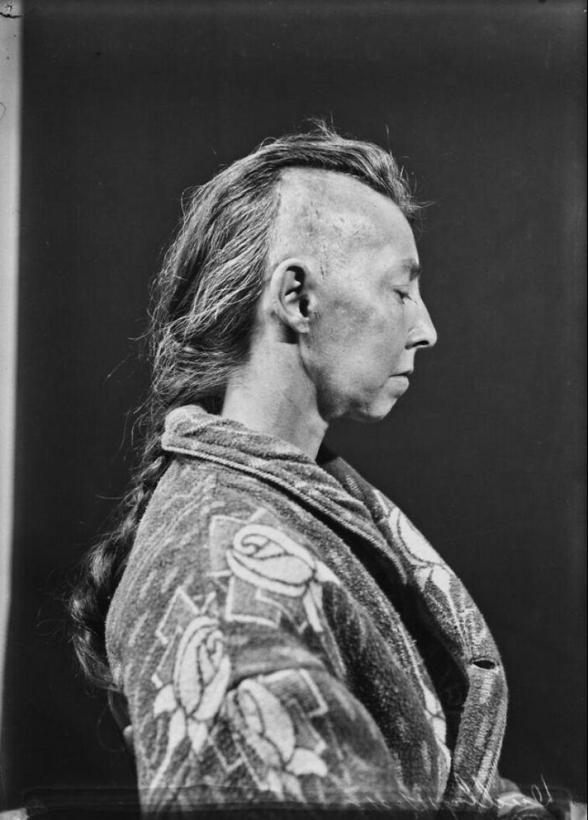 11 Haunting Medical Portraits Of Harvey Cushing’s Patients In The Early 20th Century 11 Haunting Medical Portraits Of Harvey Cushing’s Patients In The Early 20th Century