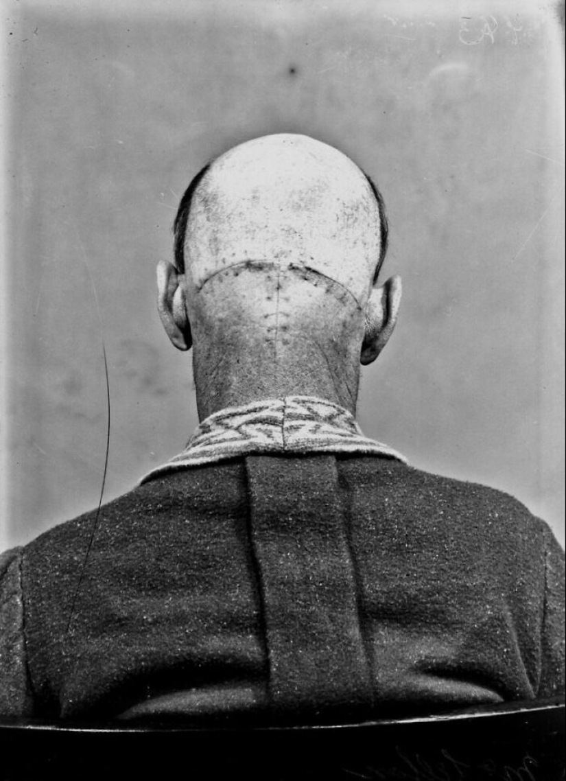11 Haunting Medical Portraits Of Harvey Cushing’s Patients In The Early 20th Century 11 Haunting Medical Portraits Of Harvey Cushing’s Patients In The Early 20th Century