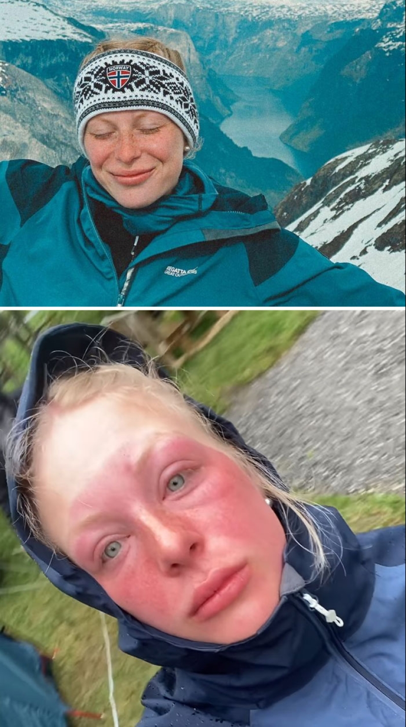 15 People Who Thought They Didn’t Need Sunscreen And Ended Up Looking Like Dorks 15 People Who Thought They Didn’t Need Sunscreen And Ended Up Looking Like Dorks