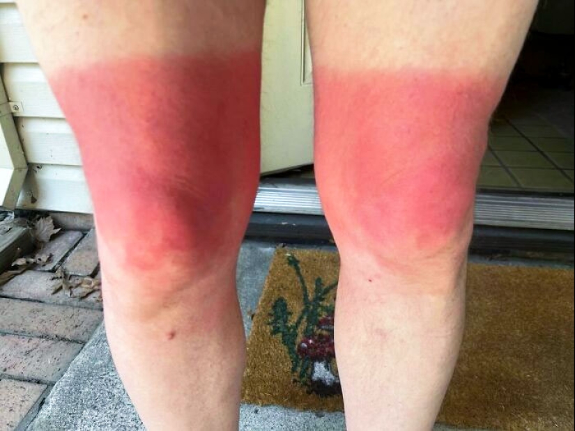 15 People Who Thought They Didn’t Need Sunscreen And Ended Up Looking Like Dorks 15 People Who Thought They Didn’t Need Sunscreen And Ended Up Looking Like Dorks