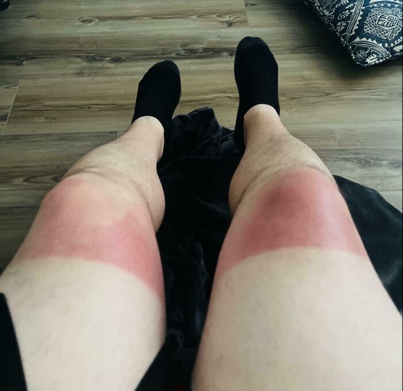 15 People Who Thought They Didn’t Need Sunscreen And Ended Up Looking Like Dorks 15 People Who Thought They Didn’t Need Sunscreen And Ended Up Looking Like Dorks